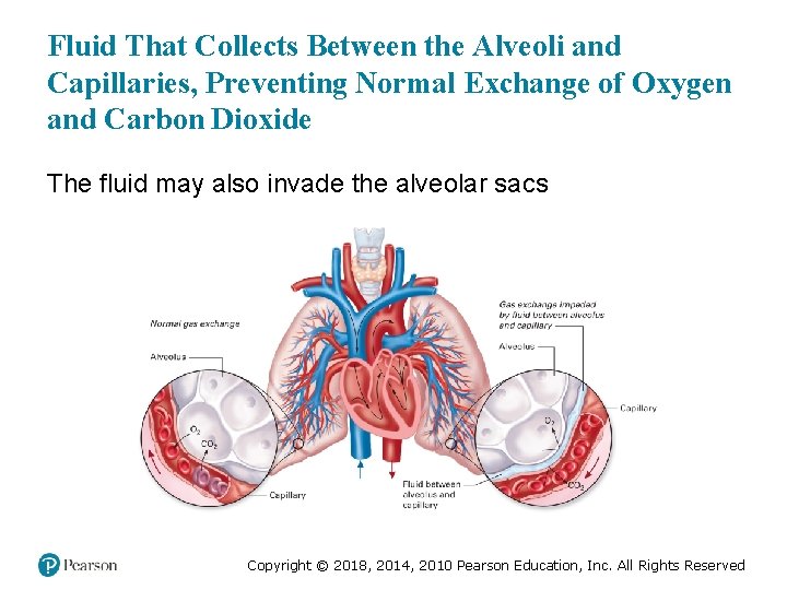 Fluid That Collects Between the Alveoli and Capillaries, Preventing Normal Exchange of Oxygen and