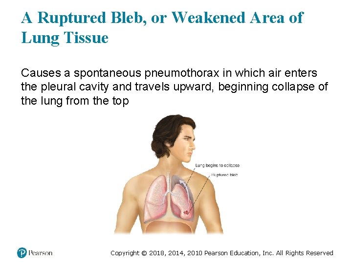 A Ruptured Bleb, or Weakened Area of Lung Tissue Causes a spontaneous pneumothorax in
