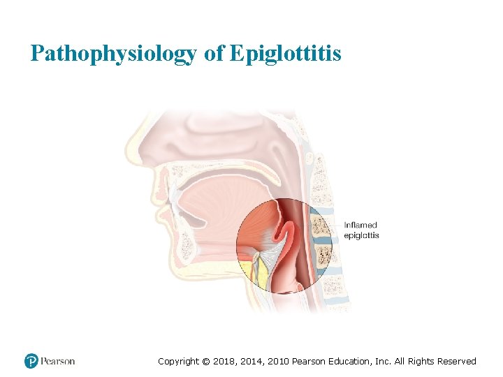 Pathophysiology of Epiglottitis Copyright © 2018, 2014, 2010 Pearson Education, Inc. All Rights Reserved