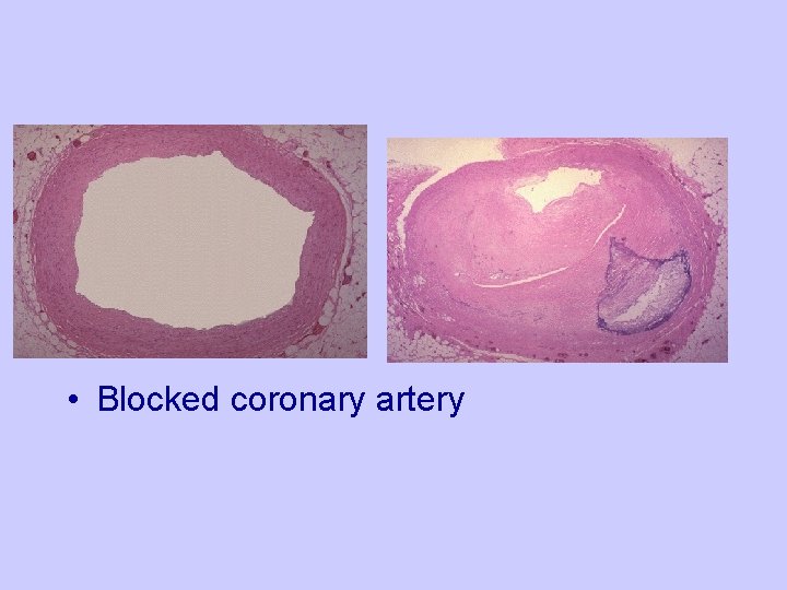  • Blocked coronary artery 