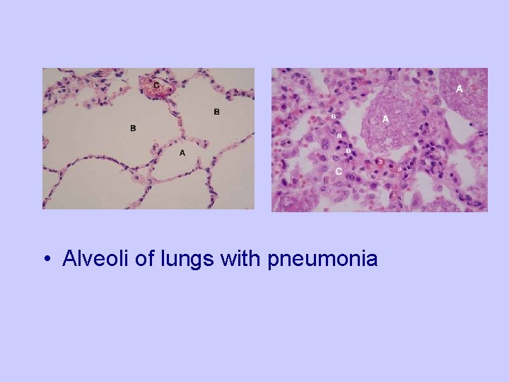  • Alveoli of lungs with pneumonia 