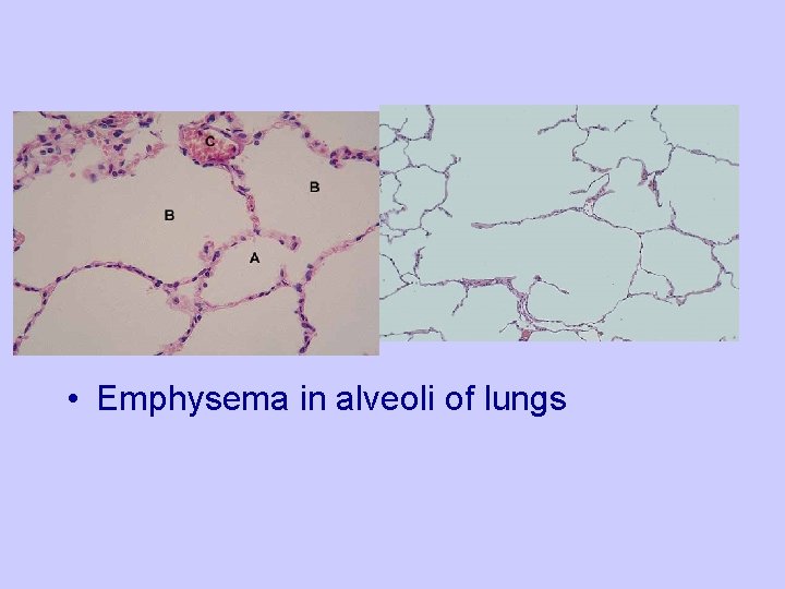  • Emphysema in alveoli of lungs 