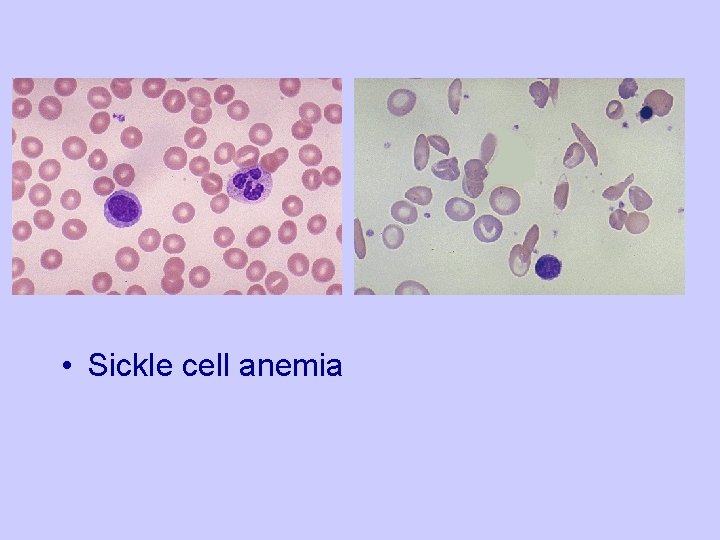  • Sickle cell anemia 