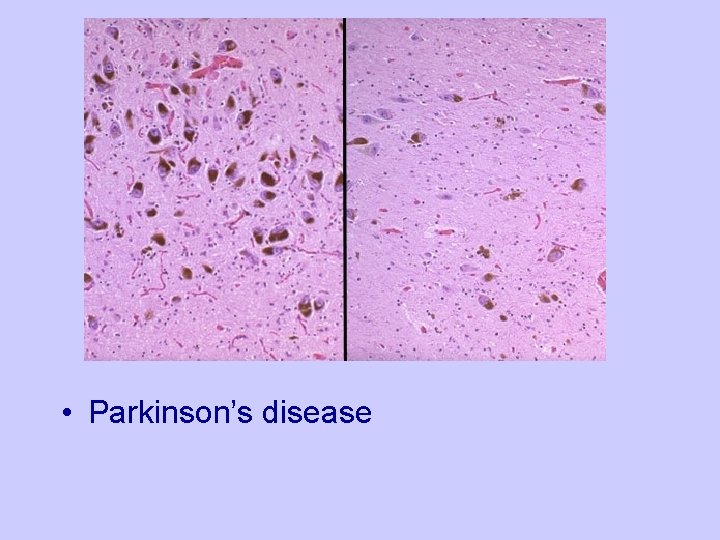  • Parkinson’s disease 