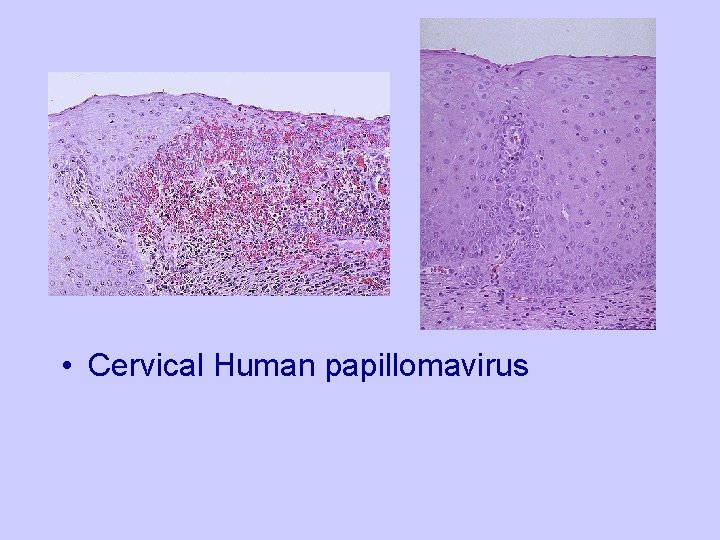  • Cervical Human papillomavirus 