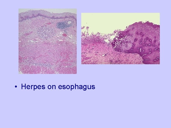  • Herpes on esophagus 