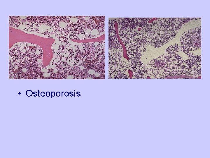  • Osteoporosis 