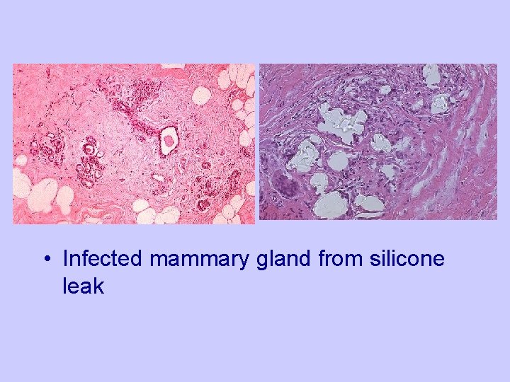  • Infected mammary gland from silicone leak 