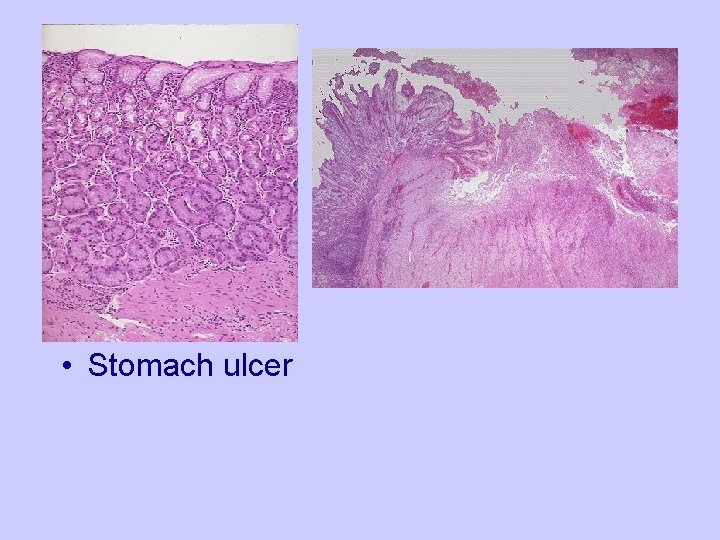  • Stomach ulcer 