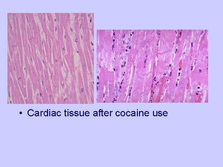  • Cardiac tissue after cocaine use 