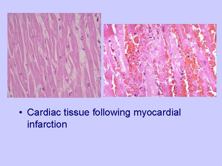  • Cardiac tissue following myocardial infarction 