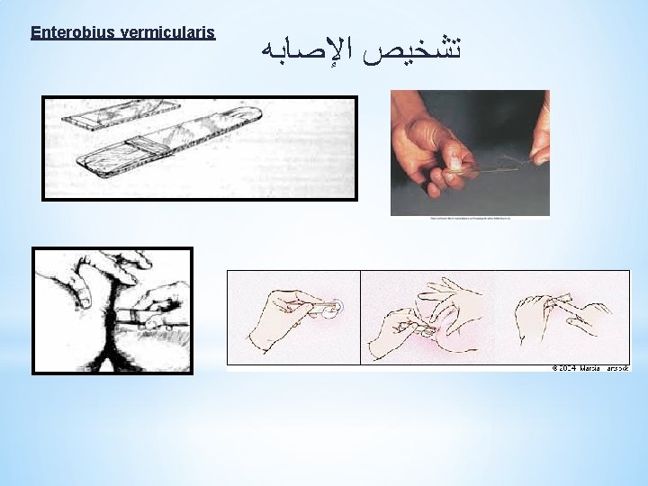 Enterobius vermicularis ﺗﺸﺨﻴﺺ ﺍﻹﺻﺎﺑﻪ 