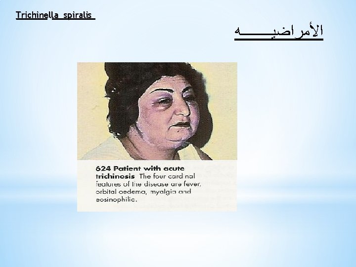 Trichinella spiralis ﺍﻷﻤﺮﺍﺿﻴــــﻪ 