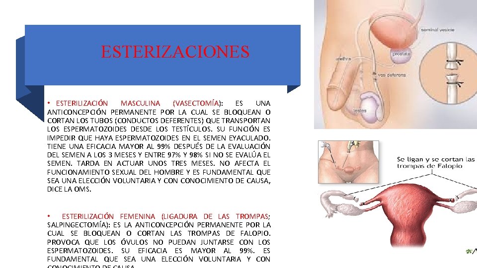 ESTERIZACIONES • ESTERILIZACIÓN MASCULINA (VASECTOMÍA): ES UNA ANTICONCEPCIÓN PERMANENTE POR LA CUAL SE BLOQUEAN