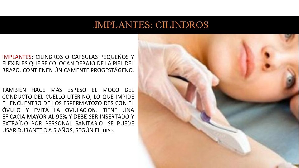 . IMPLANTES: CILINDROS O CÁPSULAS PEQUEÑOS Y FLEXIBLES QUE SE COLOCAN DEBAJO DE LA