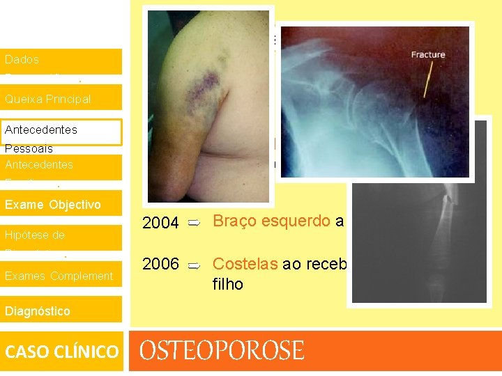 Fracturas ósseas de repetição Dados Demográficos. Queixa Principal. 2000 Antecedentes 1° e 2° dedos