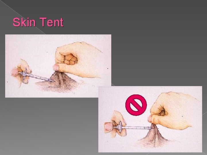 Skin Tent 