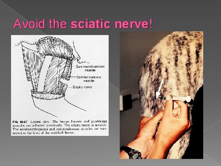 Avoid the sciatic nerve! 
