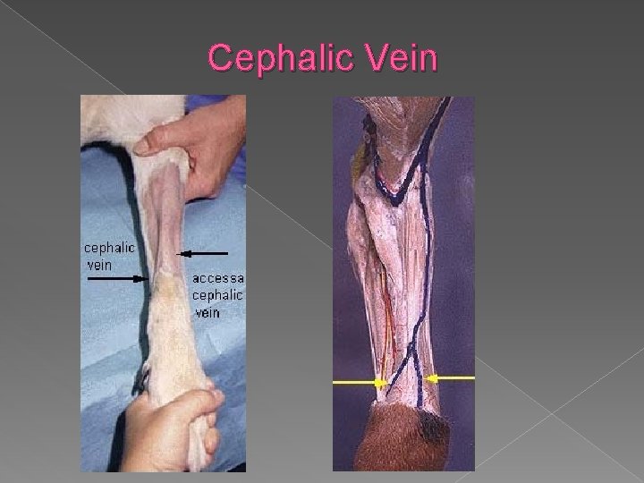 Cephalic Vein 