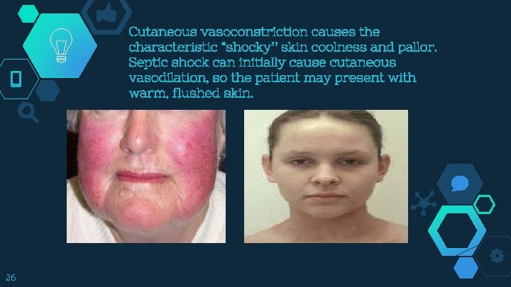 Cutaneous vasoconstriction causes the characteristic “shocky” skin coolness and pallor. Septic shock can initially
