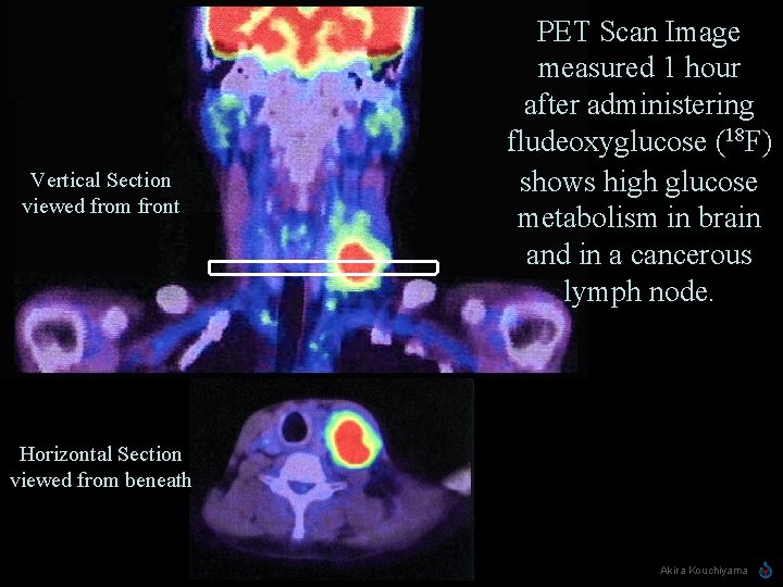 Vertical Section viewed from front PET Scan Image measured 1 hour after administering fludeoxyglucose