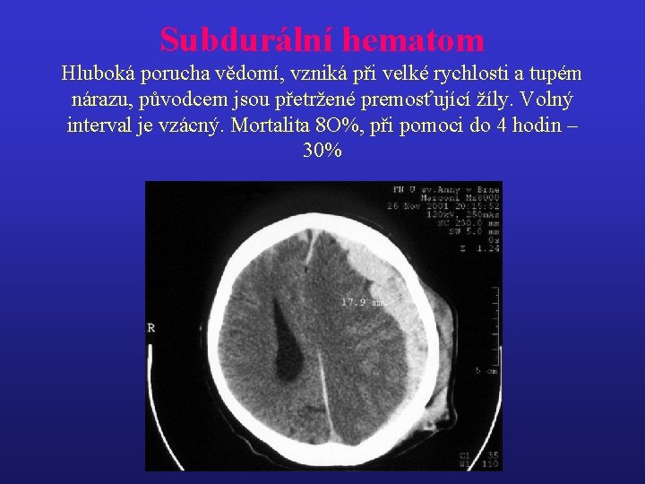 Subdurální hematom Hluboká porucha vědomí, vzniká při velké rychlosti a tupém nárazu, původcem jsou