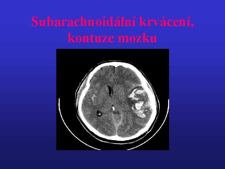 Subarachnoidální krvácení, kontuze mozku 