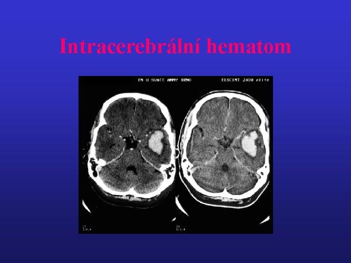 Intracerebrální hematom 