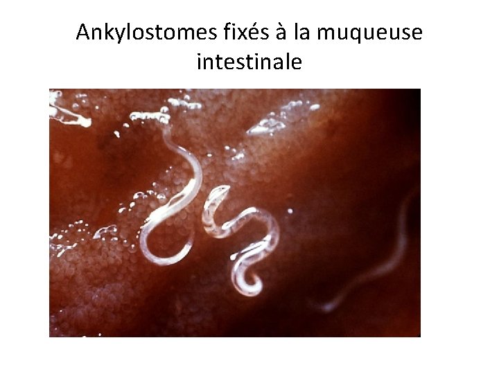 Ankylostomes fixés à la muqueuse intestinale 