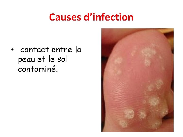 Causes d’infection • contact entre la peau et le sol contaminé. 