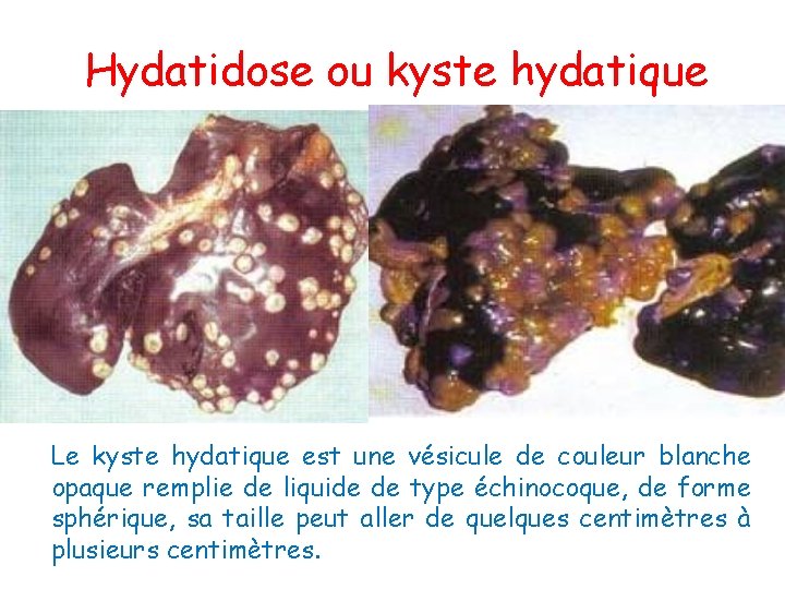Hydatidose ou kyste hydatique Le kyste hydatique est une vésicule de couleur blanche opaque