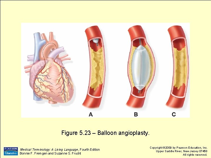 Figure 5. 23 – Balloon angioplasty. Medical Terminology: A Living Language, Fourth Edition Bonnie