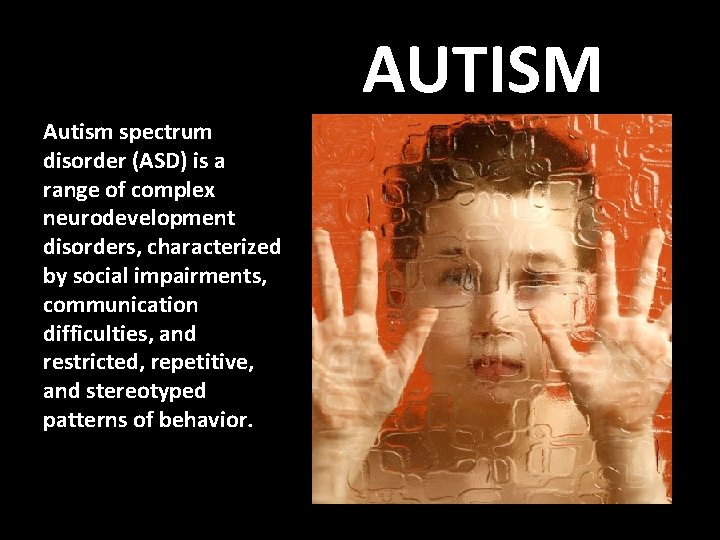 AUTISM Autism spectrum disorder (ASD) is a range of complex neurodevelopment disorders, characterized by