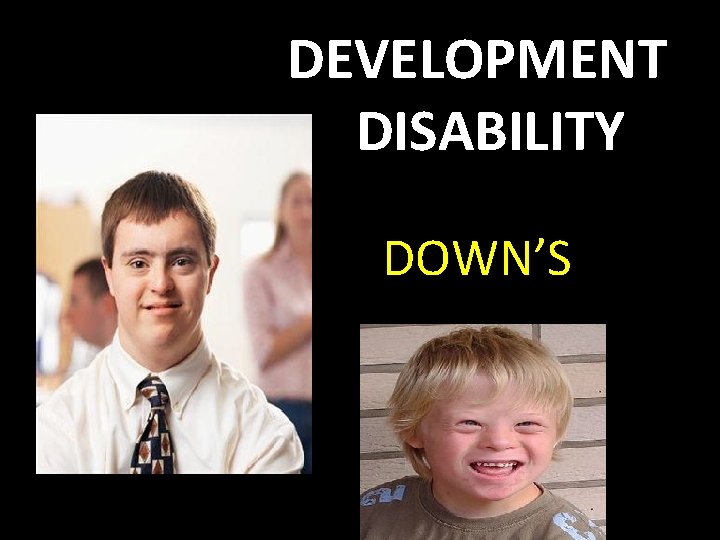 DEVELOPMENT DISABILITY DOWN’S 