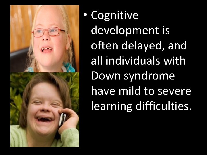  • Cognitive development is often delayed, and all individuals with Down syndrome have