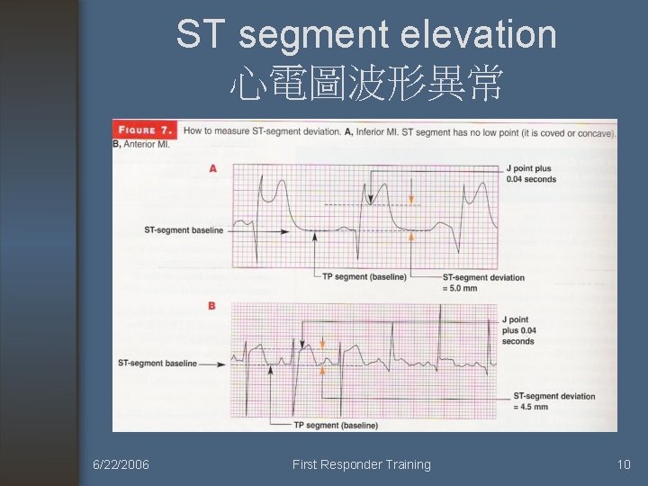 ST segment elevation 心電圖波形異常 6/22/2006 First Responder Training 10 