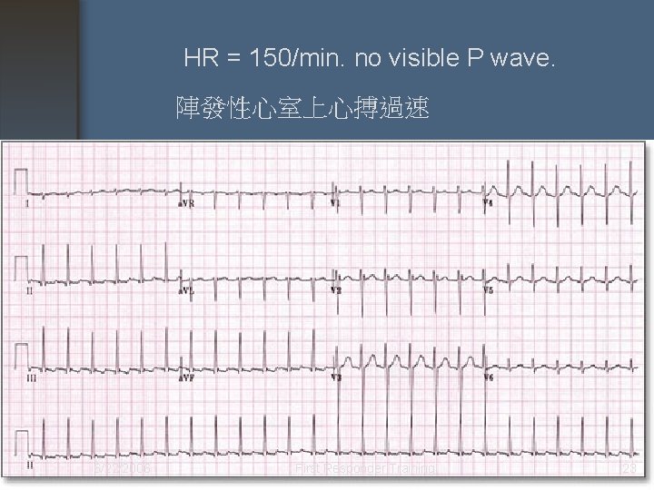 HR = 150/min. no visible P wave. 陣發性心室上心搏過速 6/22/2006 First Responder Training 23 