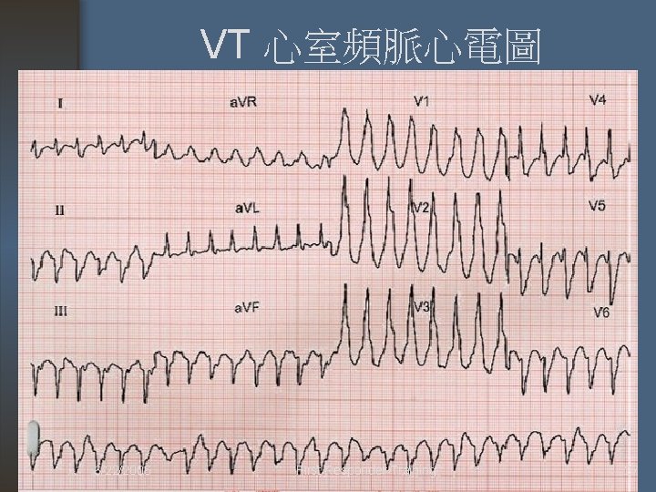 VT 心室頻脈心電圖 6/22/2006 First Responder Training 27 