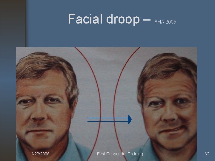 Facial droop – 6/22/2006 First Responder Training AHA 2005 62 