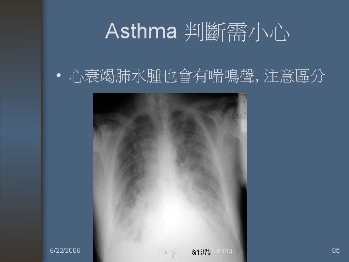 Asthma 判斷需小心 • 心衰竭肺水腫也會有喘鳴聲, 注意區分 6/22/2006 First Responder Training 85 