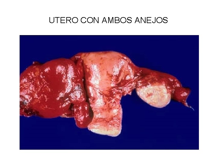 UTERO CON AMBOS ANEJOS 