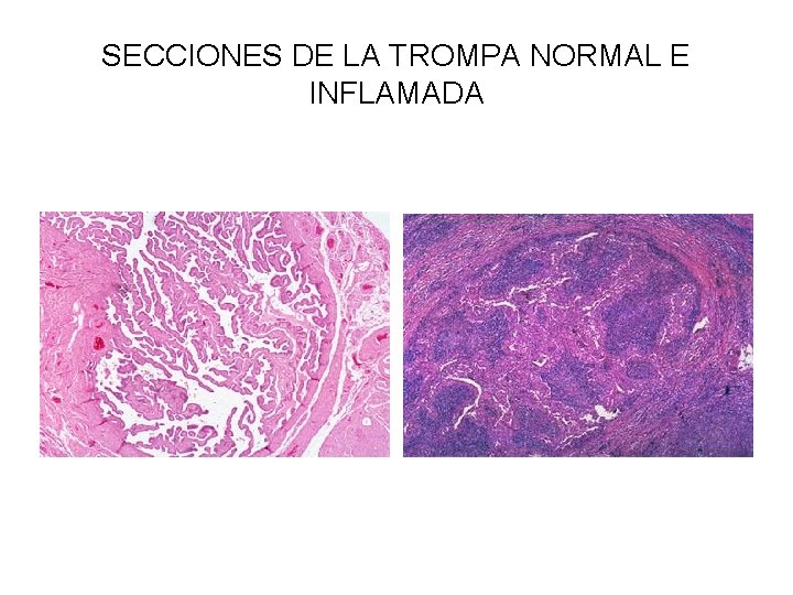 SECCIONES DE LA TROMPA NORMAL E INFLAMADA 