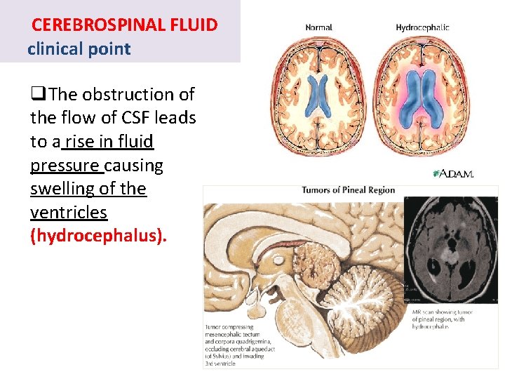 CEREBROSPINAL FLUID clinical point q. The obstruction of the flow of CSF leads to