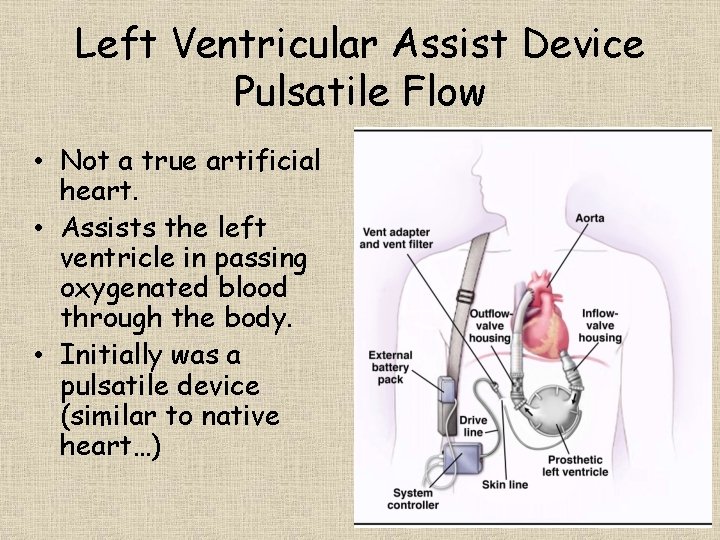 Left Ventricular Assist Device Pulsatile Flow • Not a true artificial heart. • Assists