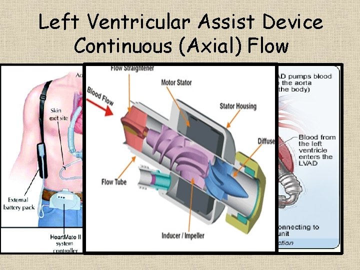 Left Ventricular Assist Device Continuous (Axial) Flow 