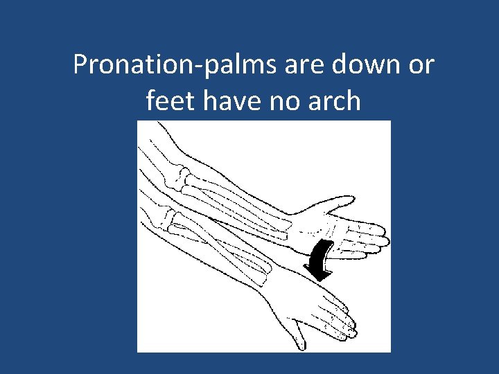 Pronation-palms are down or feet have no arch 