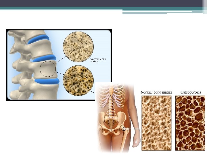 Osteoporosis 