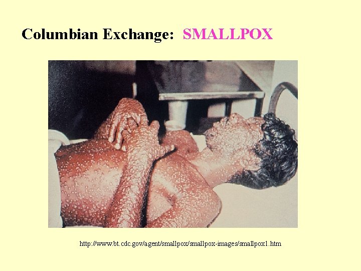 Columbian Exchange: SMALLPOX http: //www. bt. cdc. gov/agent/smallpox-images/smallpox 1. htm 