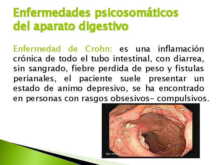 Enfermedades psicosomáticos del aparato digestivo Enfermedad de Crohn: es una inflamación crónica de todo