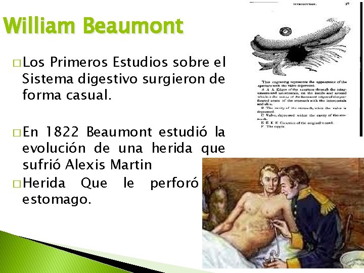 William Beaumont � Los Primeros Estudios sobre el Sistema digestivo surgieron de forma casual.